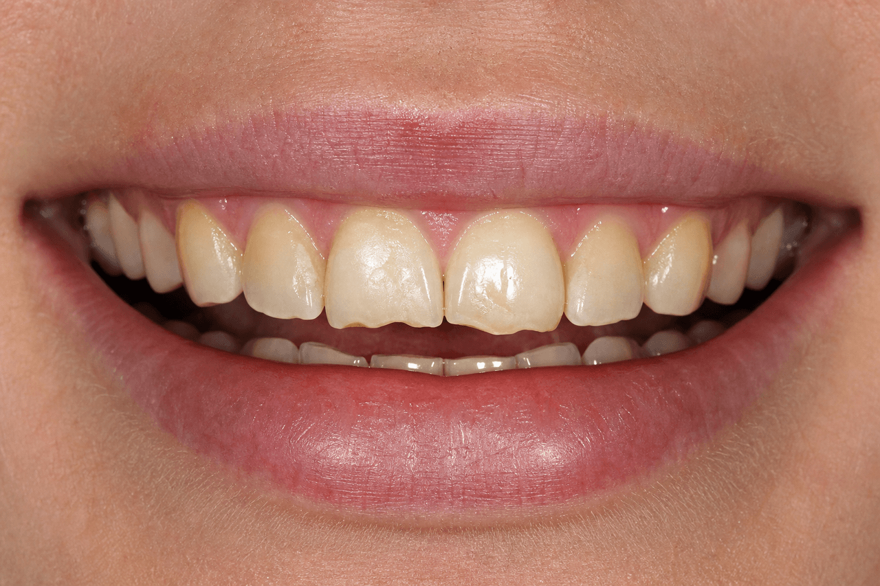 Before — Porcelain veneer smile makeover