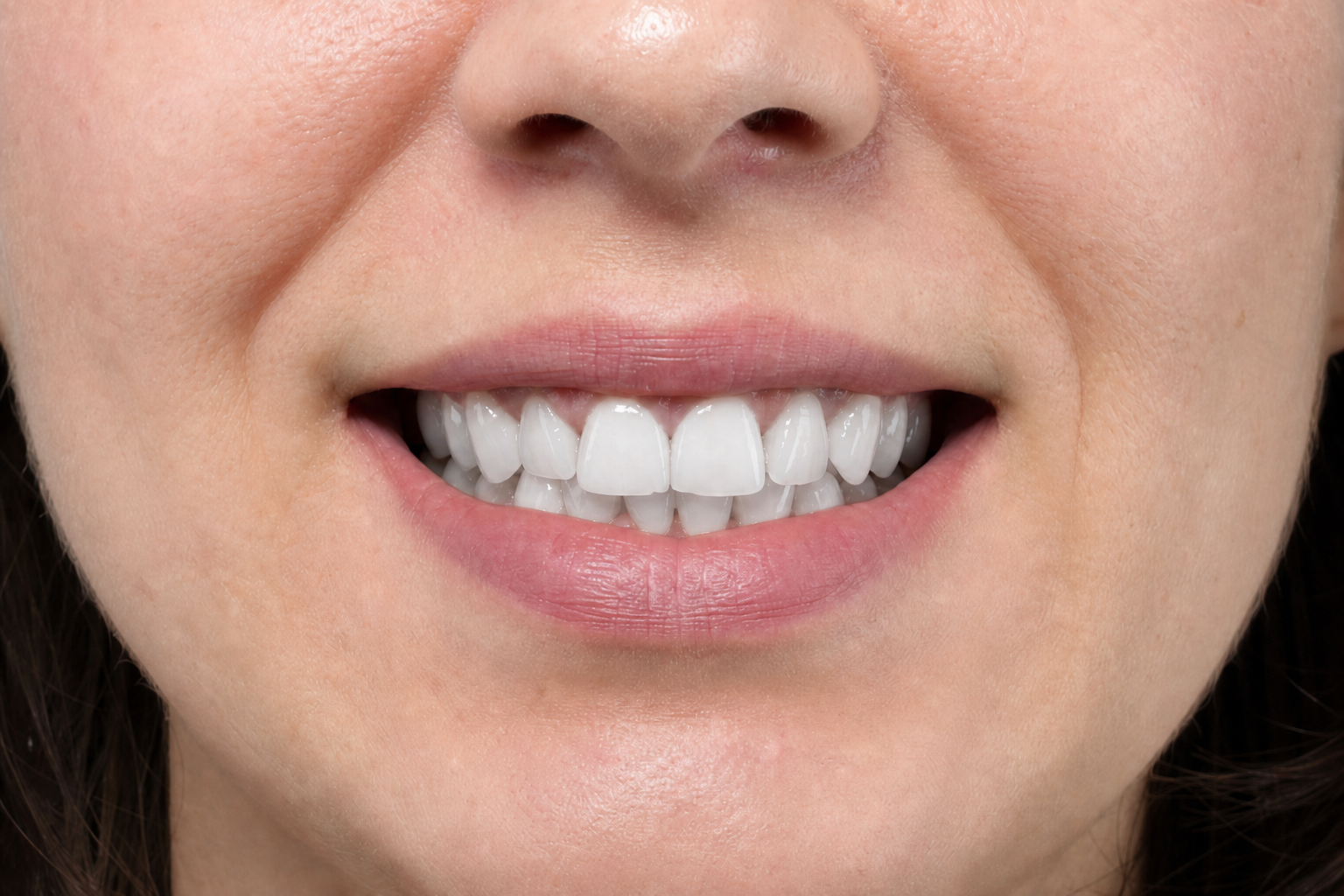 After — Female patient · Stained enamel