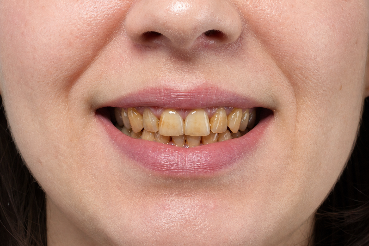 Before — Female patient · Stained enamel